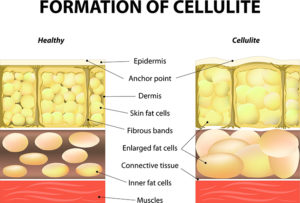 Formation of Cellulite